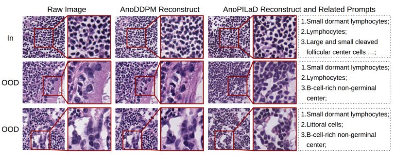 Pathology-Informed Latent Diffusion Model for Anomaly Detection in Lymph Node Metastasis